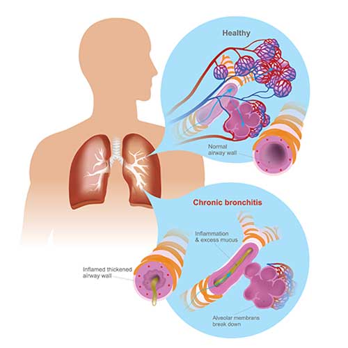 Chronic Bronchitis Symptoms, Causes and Treatment