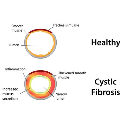 ACystic Fibrosis Symptoms, Causes and Treatment