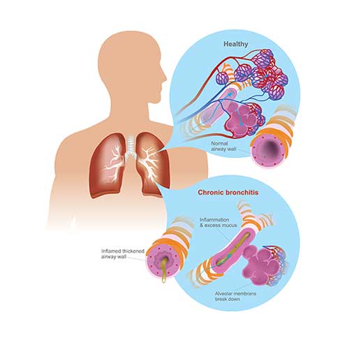 Acute Bronchitis Symptoms, Causes and Treatment