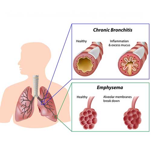 COPD Bronchitis Symptoms, Causes and Treatment