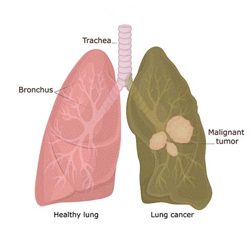 Lung Cancer Symptoms, Causes and Treatment