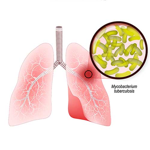 Tuberculosis Symptoms, Causes and Treatment